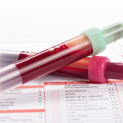 Blutproben liegen auf einem Laborformular zur Festellung der Blutwerte